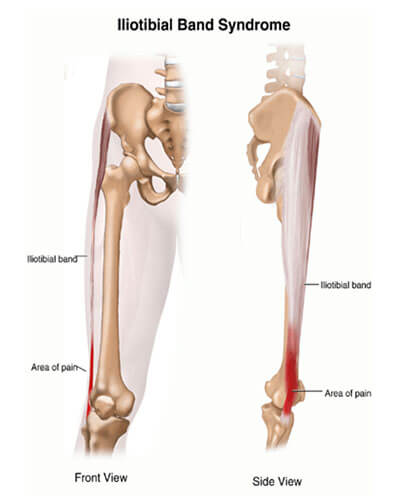 ITB (Iliotibial band) Friction Syndrome - Range Physiotherapy